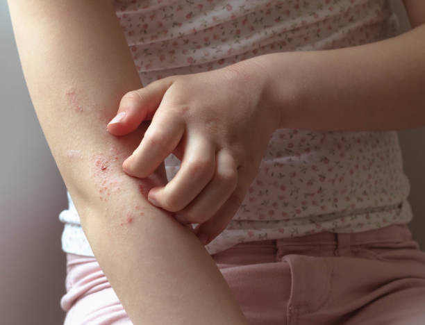 Recognizing Allergies in Children: Practical Tips for Effective Management